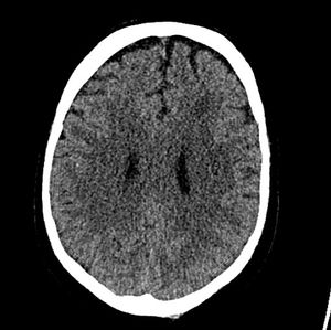 NEXUS score vs CT scan findings.