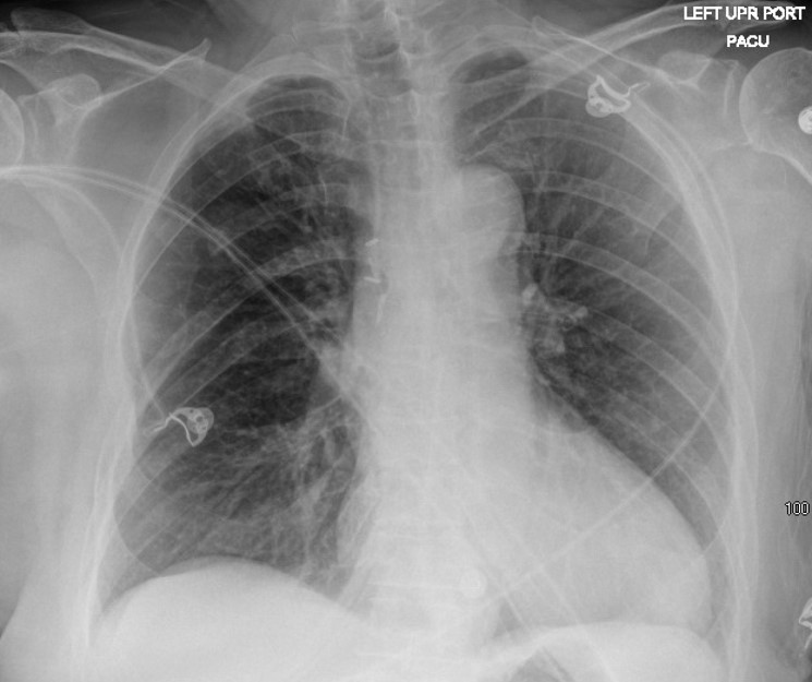 Transthoracic Retropleural Approach To Thoracic Discectomy