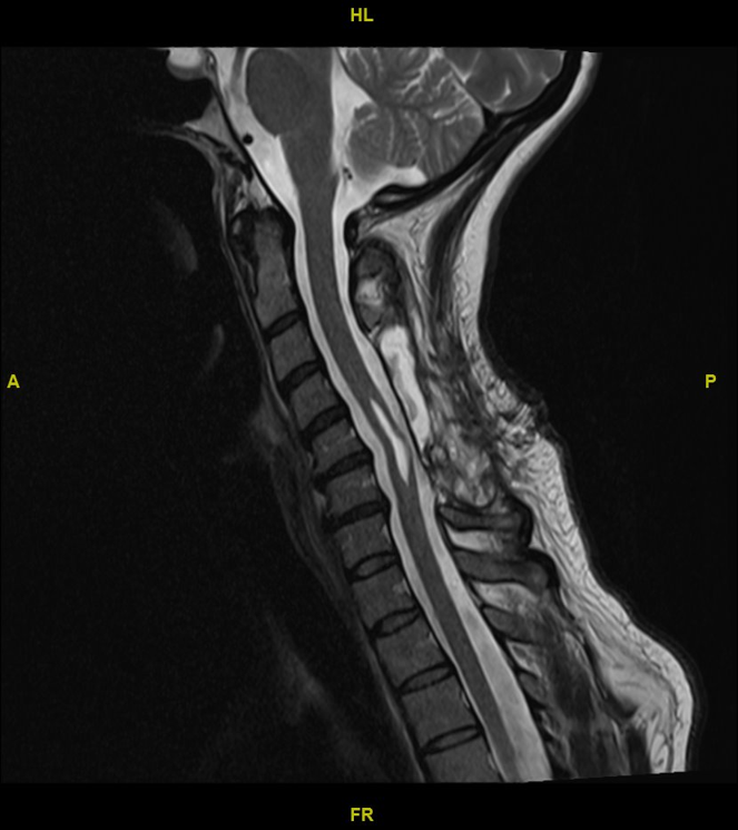 Shunting Of Syringomyelia After Cervical Ependymoma Resection - Cns.org