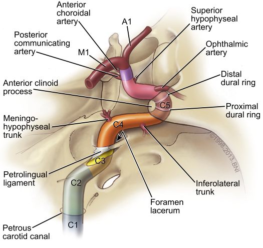 Right pterional craniotomy for carotid terminus aneurysm - cns.org