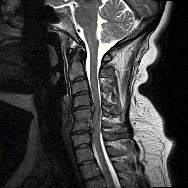 Cloward Dowel ACDF for Cervical Stenosis - cns.org