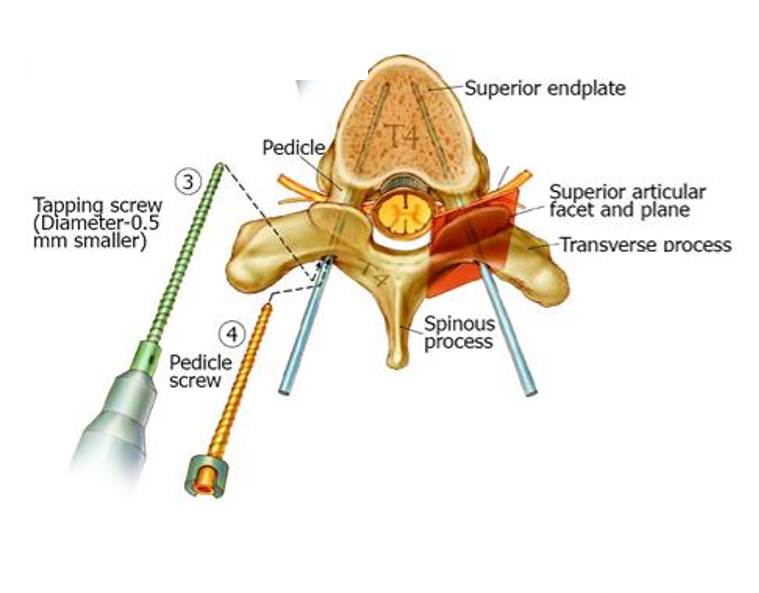 L1-5 posterior instrumented fusion for lumbar burst fracture - cns.org