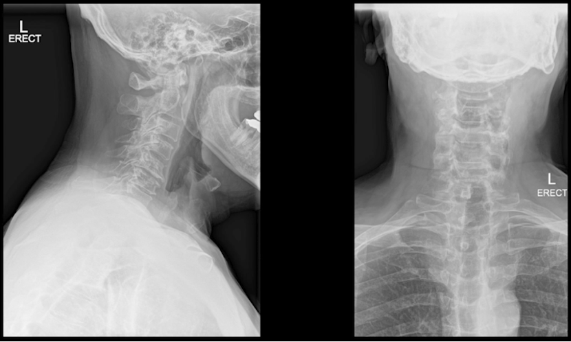 Posterior Cervical Laminectomy And Fusion 