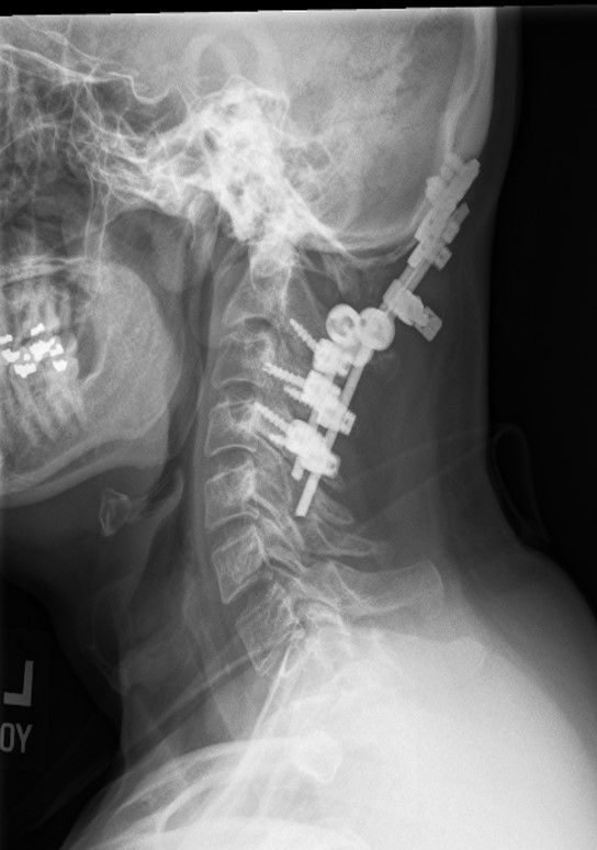 Suboccipital Craniectomy, and Occipitocervical fusion for Chiari ...