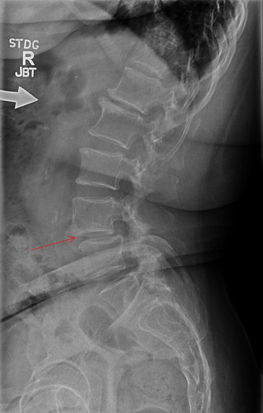 Stand Alone Anterior to Psoas Lumbar Interbody Fusion for Degenerative ...