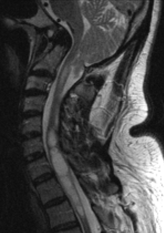 Suboccipital Craniectomy, and Occipitocervical fusion for Chiari ...