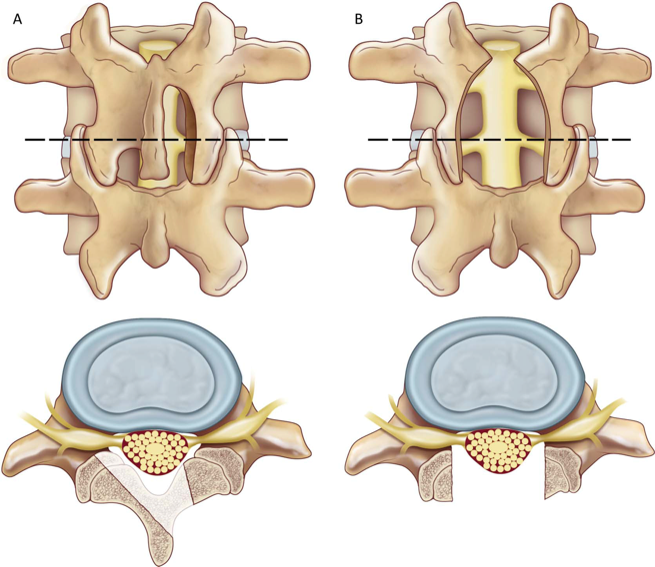 Minimally invasive discectomy L4-5 - cns.org