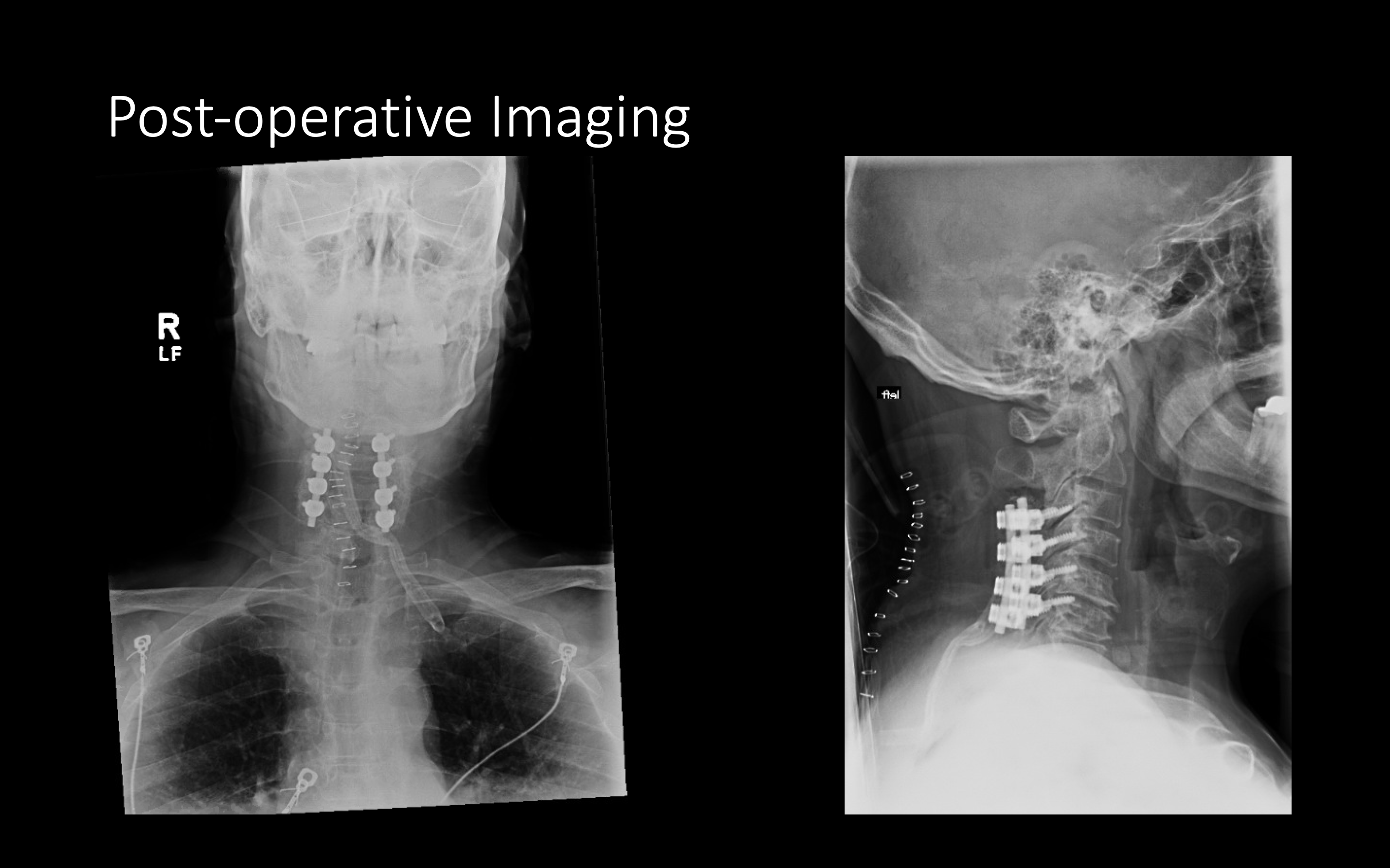 Posterior Cervical Laminectomy And Fusion 0648