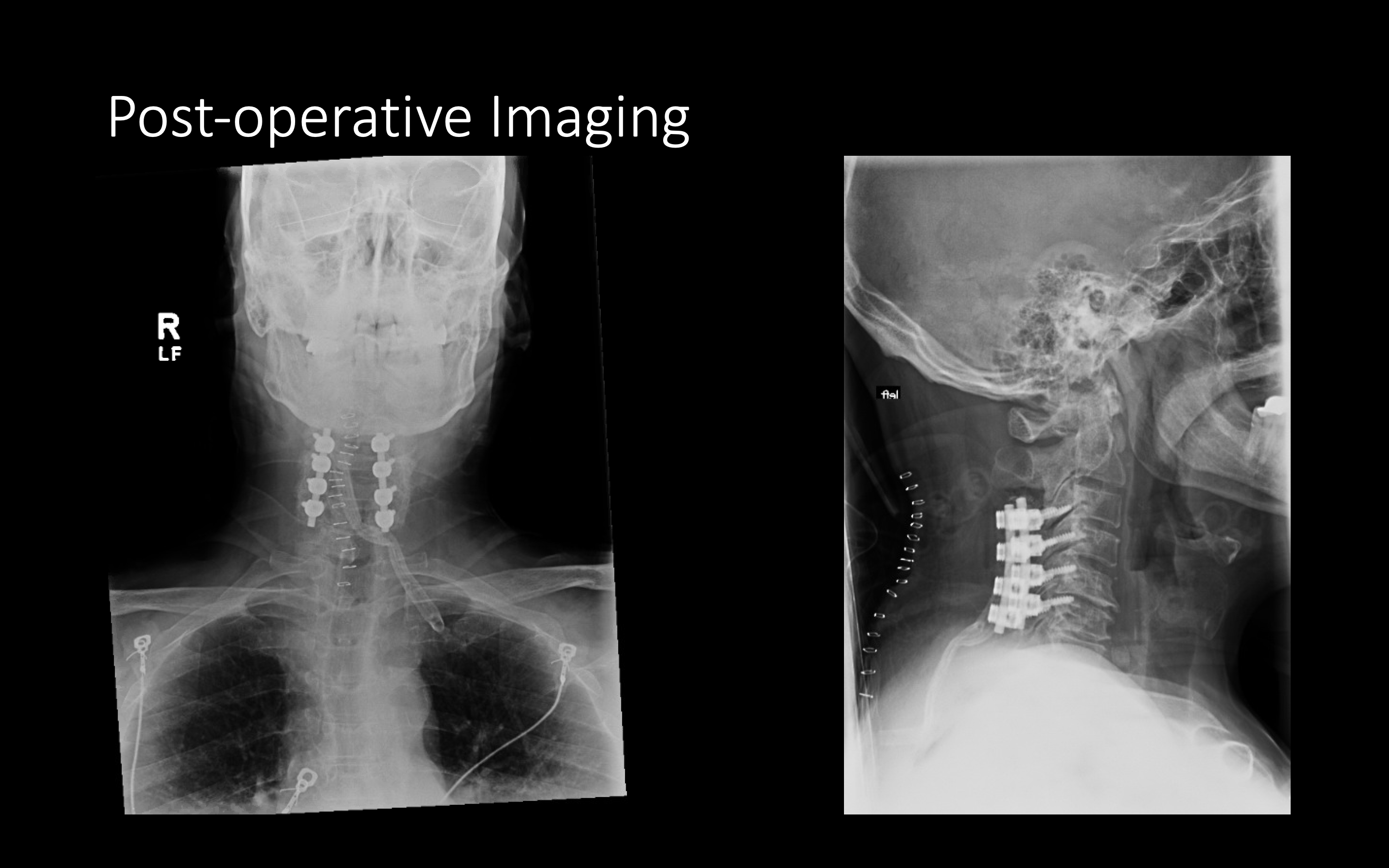 Posterior Cervical Laminectomy And Fusion