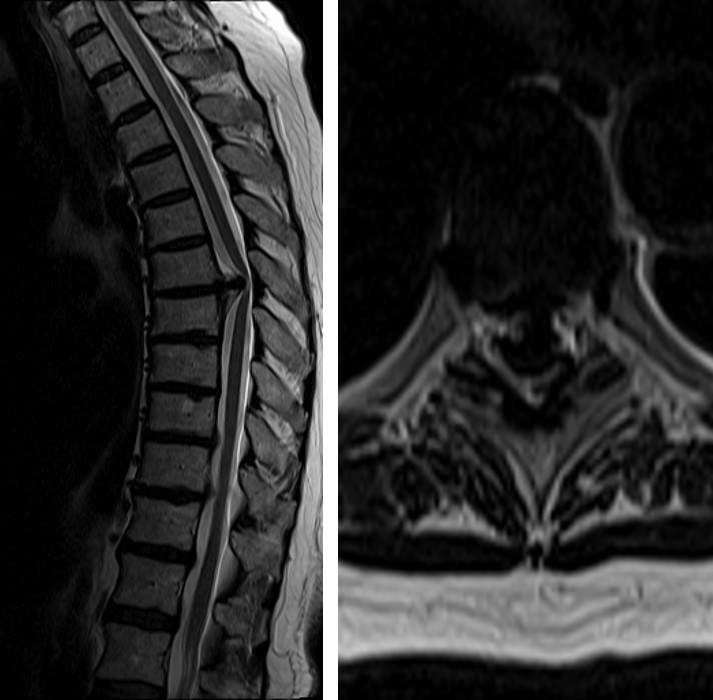 Transthoracic Retropleural Approach To Thoracic Discectomy