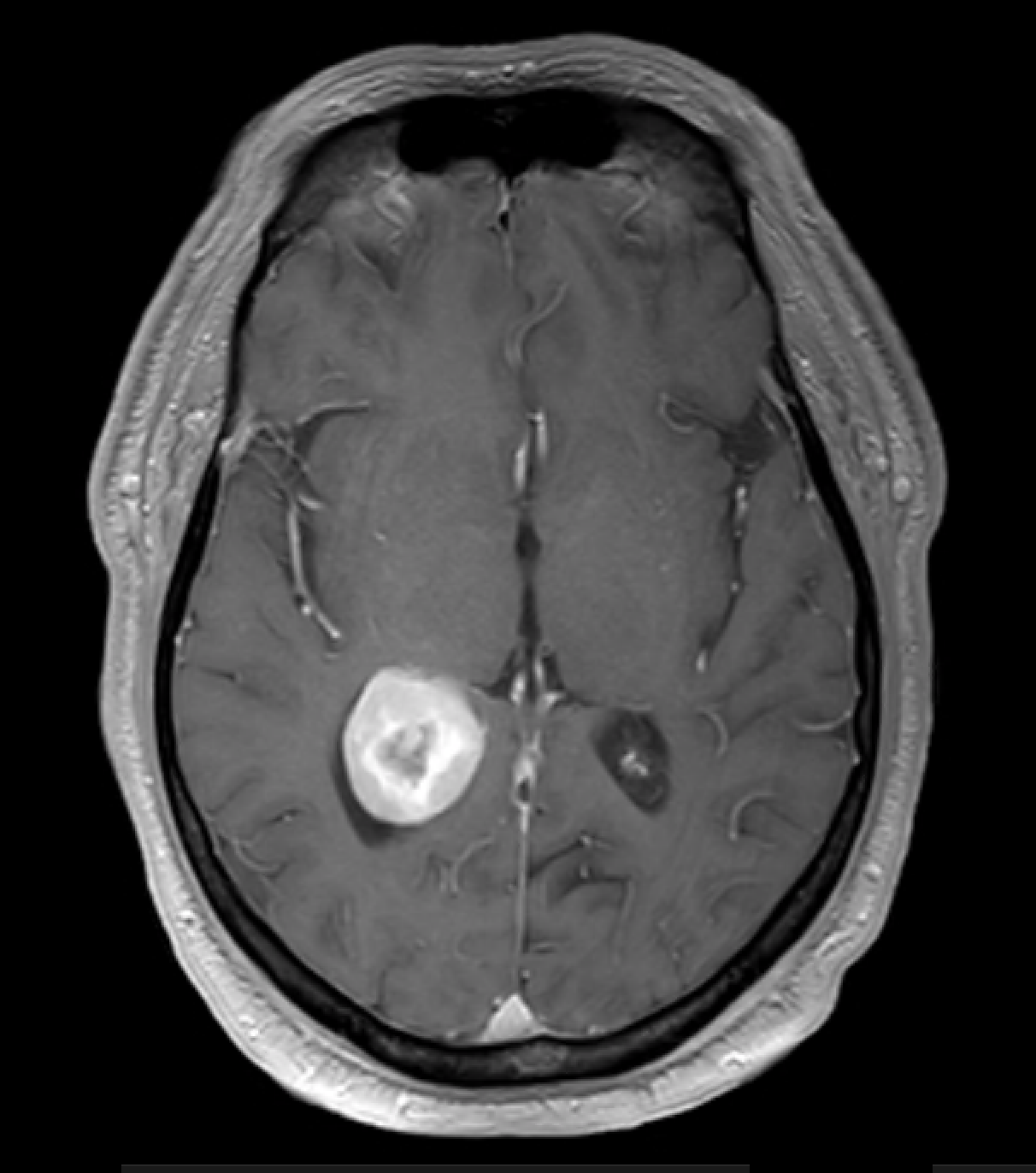 Transtemporal resection of an intraventricular meningioma using Vycor ...