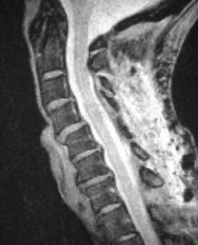 Posterior Cervical Laminoplasty For Degenerative Cervical Stenosis 