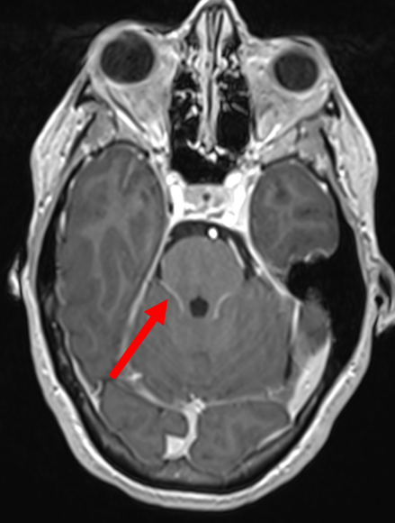 Ommaya Reservoir Placement for Intrathecal Chemotherapy - cns.org