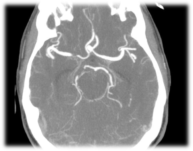 Right Pterional Approach For Clipping Of Anterior Communicating Artery 