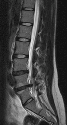 Minimally invasive discectomy L4-5 - cns.org