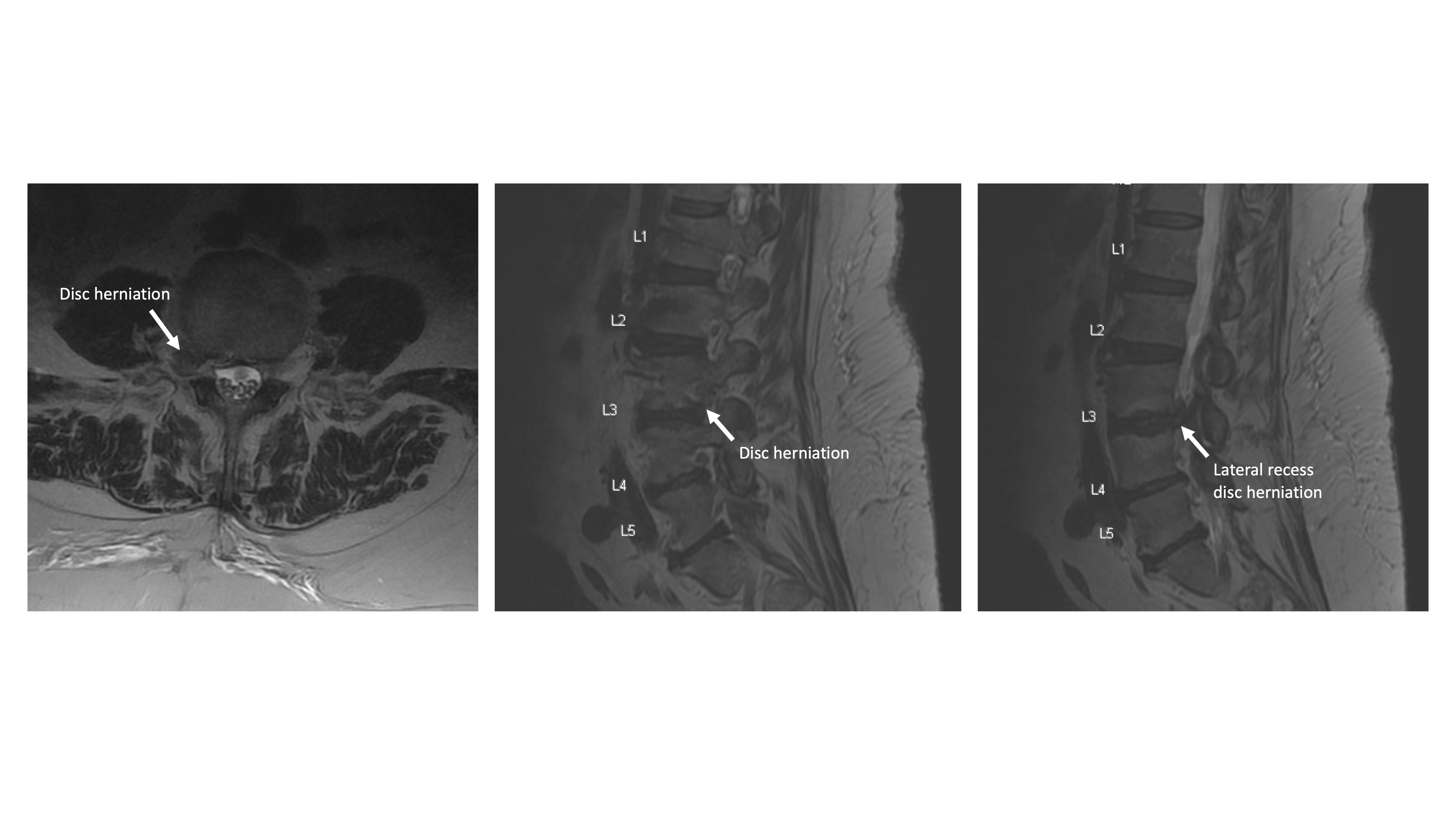 Transforaminal Endoscopic Lumbar Microdiscectomy Via Transforaminal