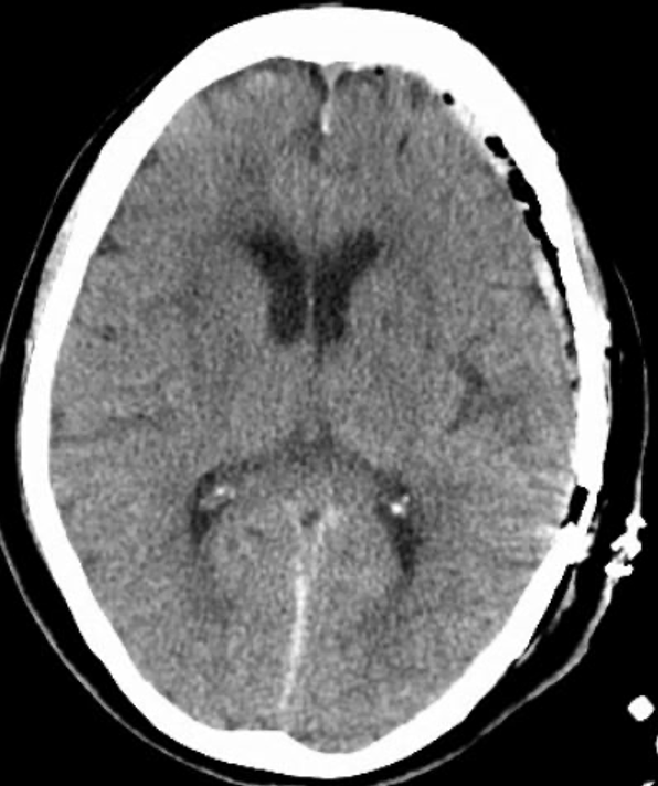 Craniotomy for Evacuation of Acute Subdural Hematoma After Acute ...