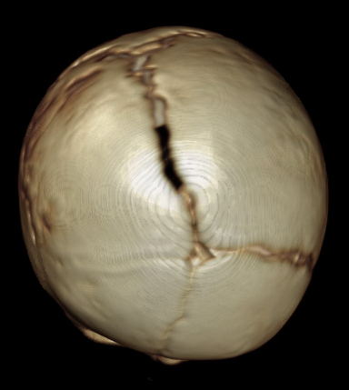 Fronto-orbital advancement for unicoronal craniosynostosis - cns.org