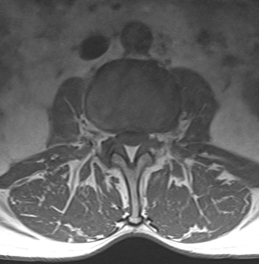 Lumbar laminectomy for severe stenosis due to epidural lipomatosis ...