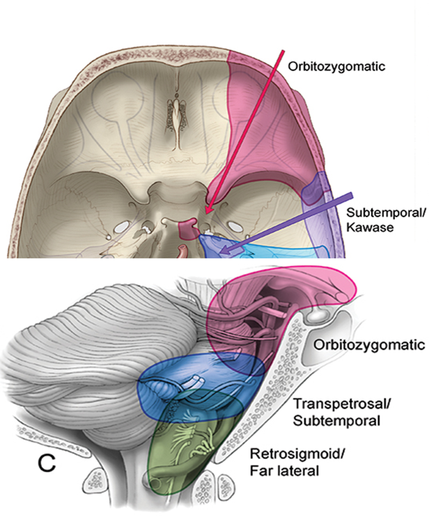 Orbitozygomatic Approach - cns.org