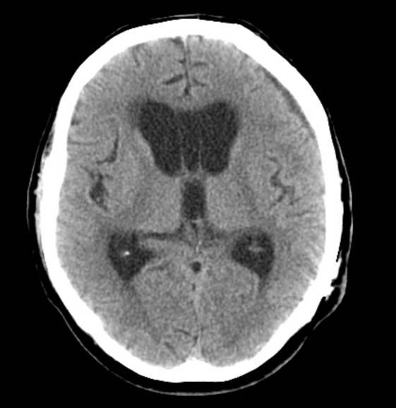 Decompressive Craniectomy for Subdural Hematoma Complicated by Post ...