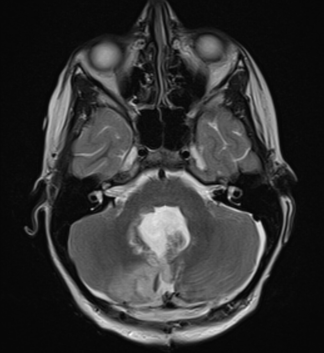 Suboccipital craniotomy for resection of a 4th ventricular tumor - cns.org