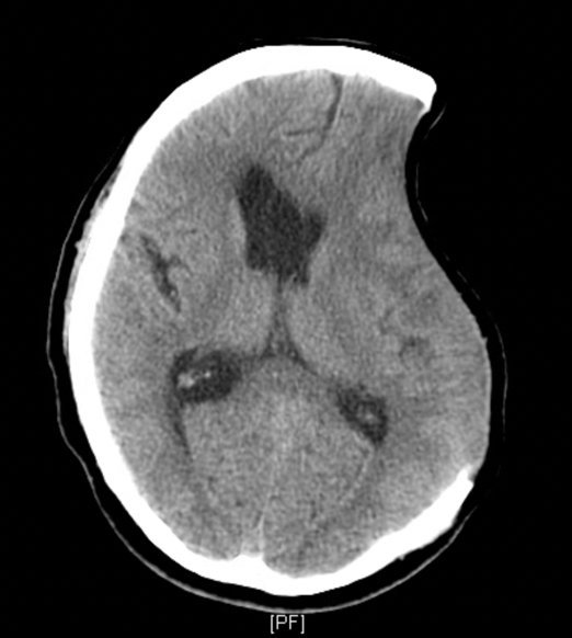 Decompressive Craniectomy for Subdural Hematoma Complicated by Post ...