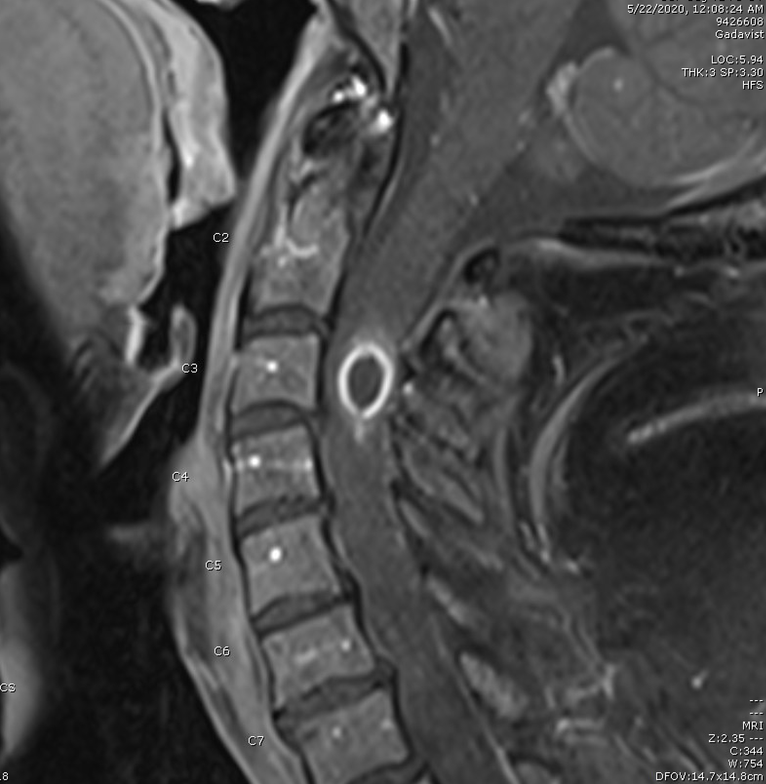 Jcm Free Full Text Intramedullary Spinal Cord Abscess With