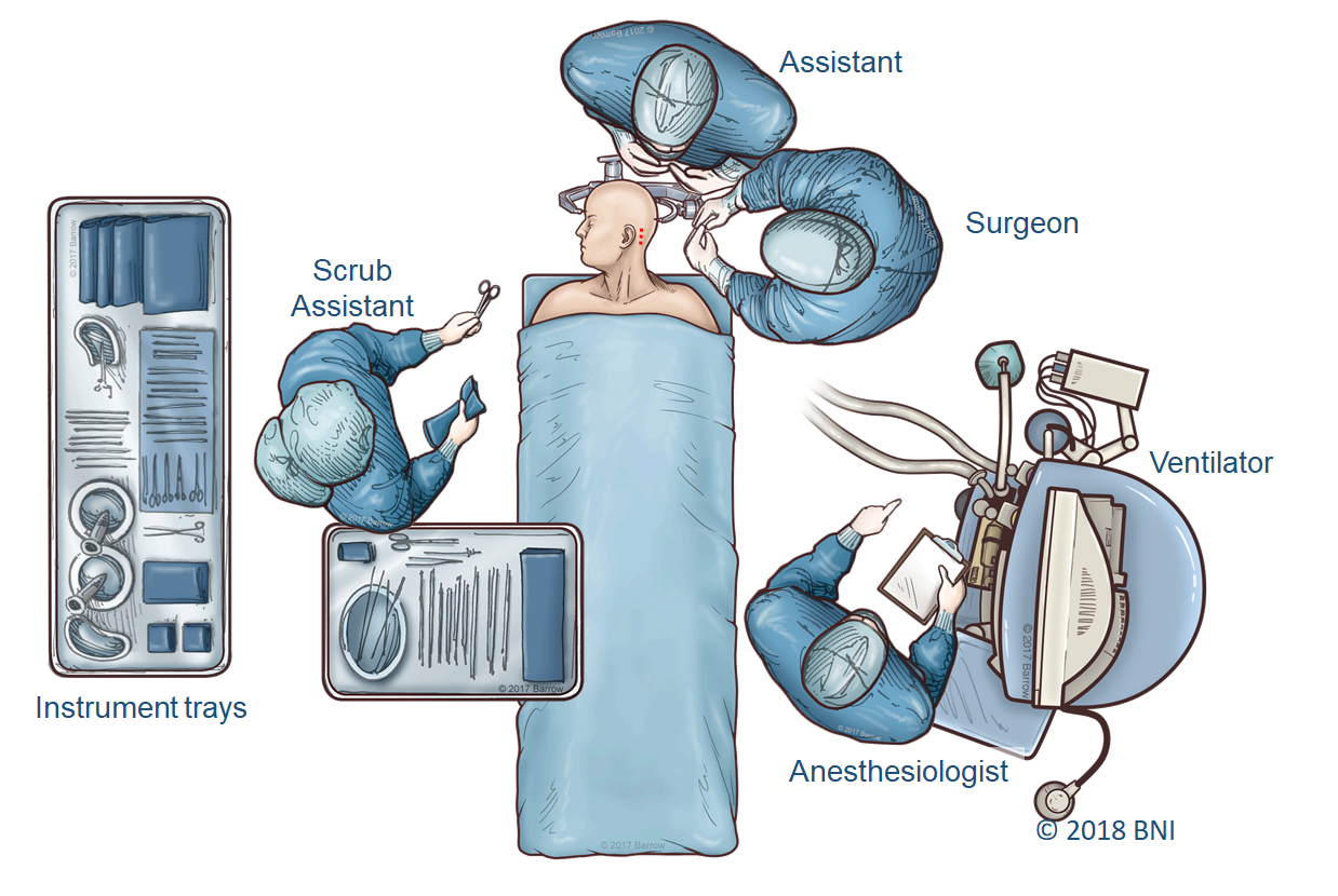 Right retrosigmoid craniotomy for microvascular decompression for ...