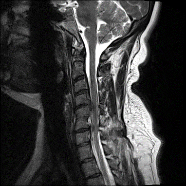 Cloward Dowel ACDF for Cervical Stenosis - cns.org