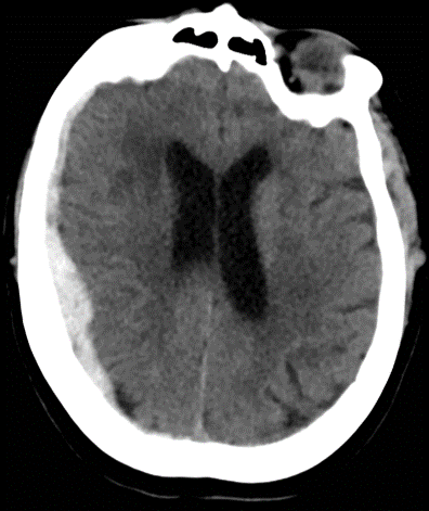 Acute Subdural Hematoma Craniotomy Evacuation - cns.org