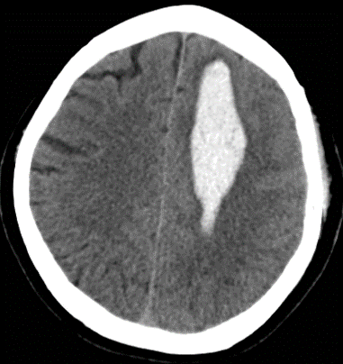 Intraventricular hemorrhage - cns.org