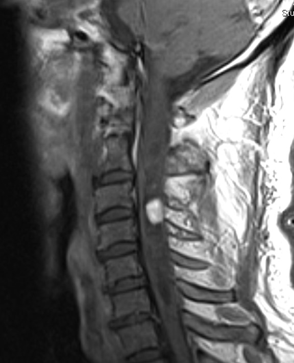 Cervical Laminectomy and Resection of C3-4 Intramedullary ...