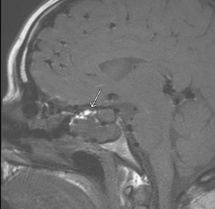 Endonasal Endoscopic Approach For Prolactinoma Failed Medical 