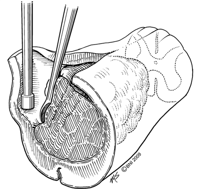 Laminectomy for Ependymoma of the Cervical Spine - cns.org