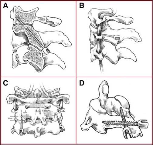 Suboccipital Craniectomy, and Occipitocervical fusion for Chiari ...