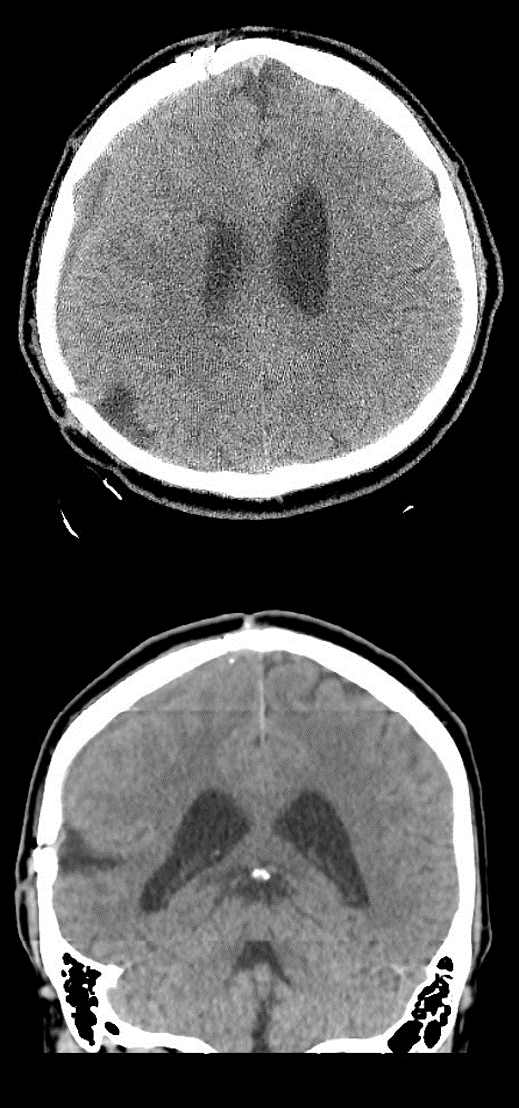 Craniectomy For Refractory Intracranial Hypertension