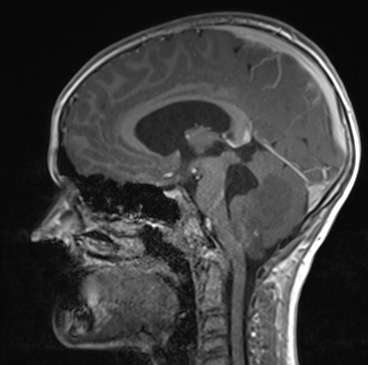 Suboccipital craniotomy for resection of a 4th ventricular tumor - cns.org