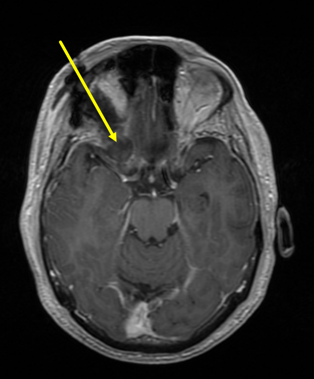 Right supraorbital craniotomy for anterior clinoidal process meningioma ...