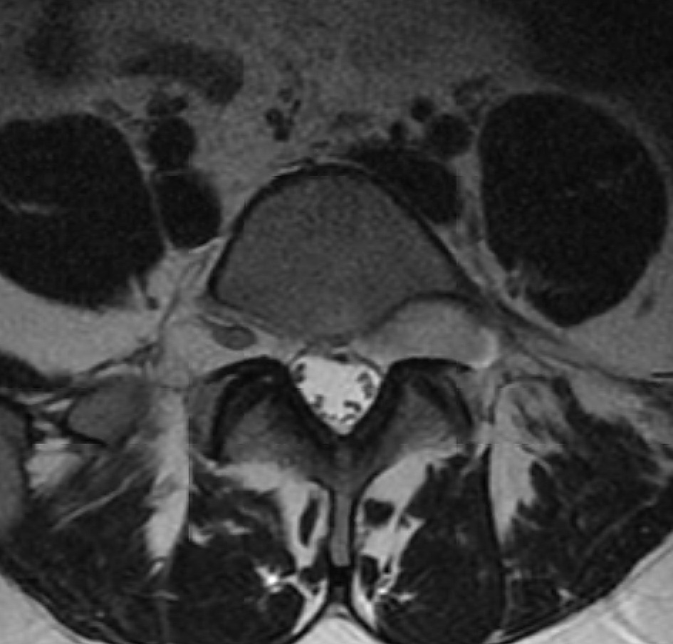 Resection of lumbar dumbbell schwannoma - cns.org