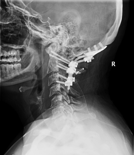 Occipito Cervical Fusion For Tumor Destruction Of Occipital Condyle