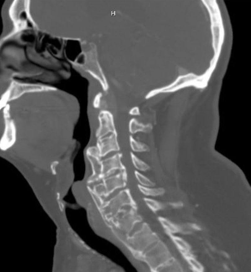 Anterior cervical osteophytectomy for treatment of dysphagia - cns.org