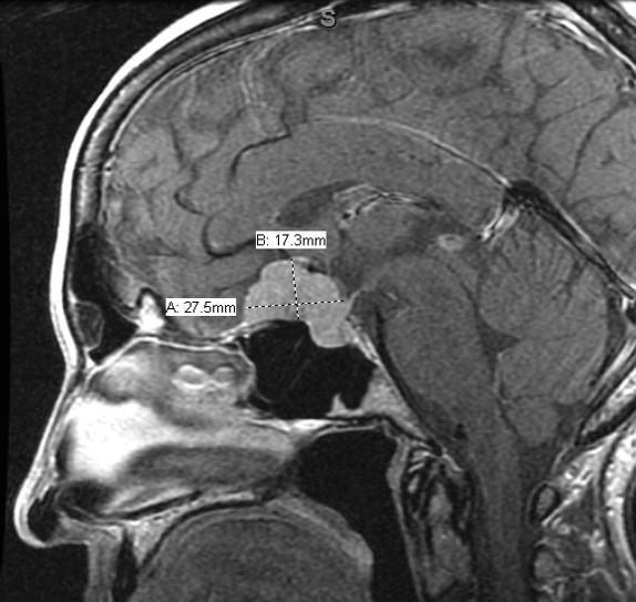 Transnasal Endoscopic Resection Of Anterior Skull Base Meningioma