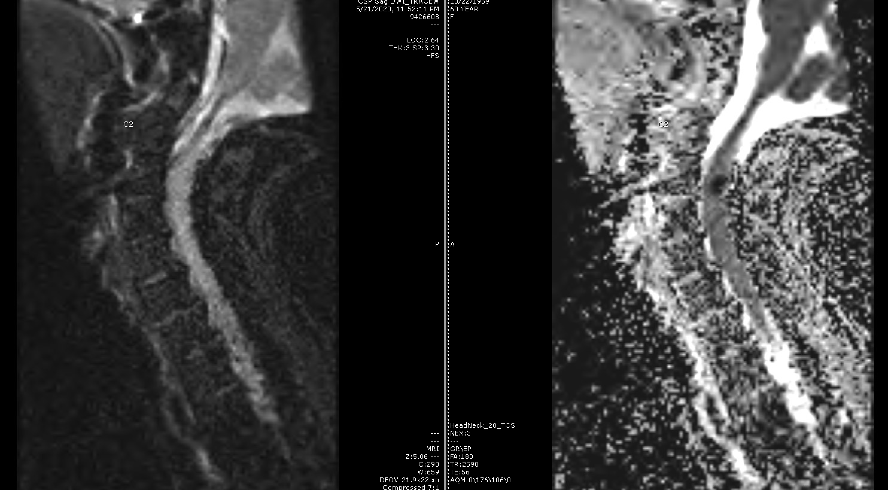 Pdf Cervical Spinal Cord Intramedullary Abscess Streptococcus